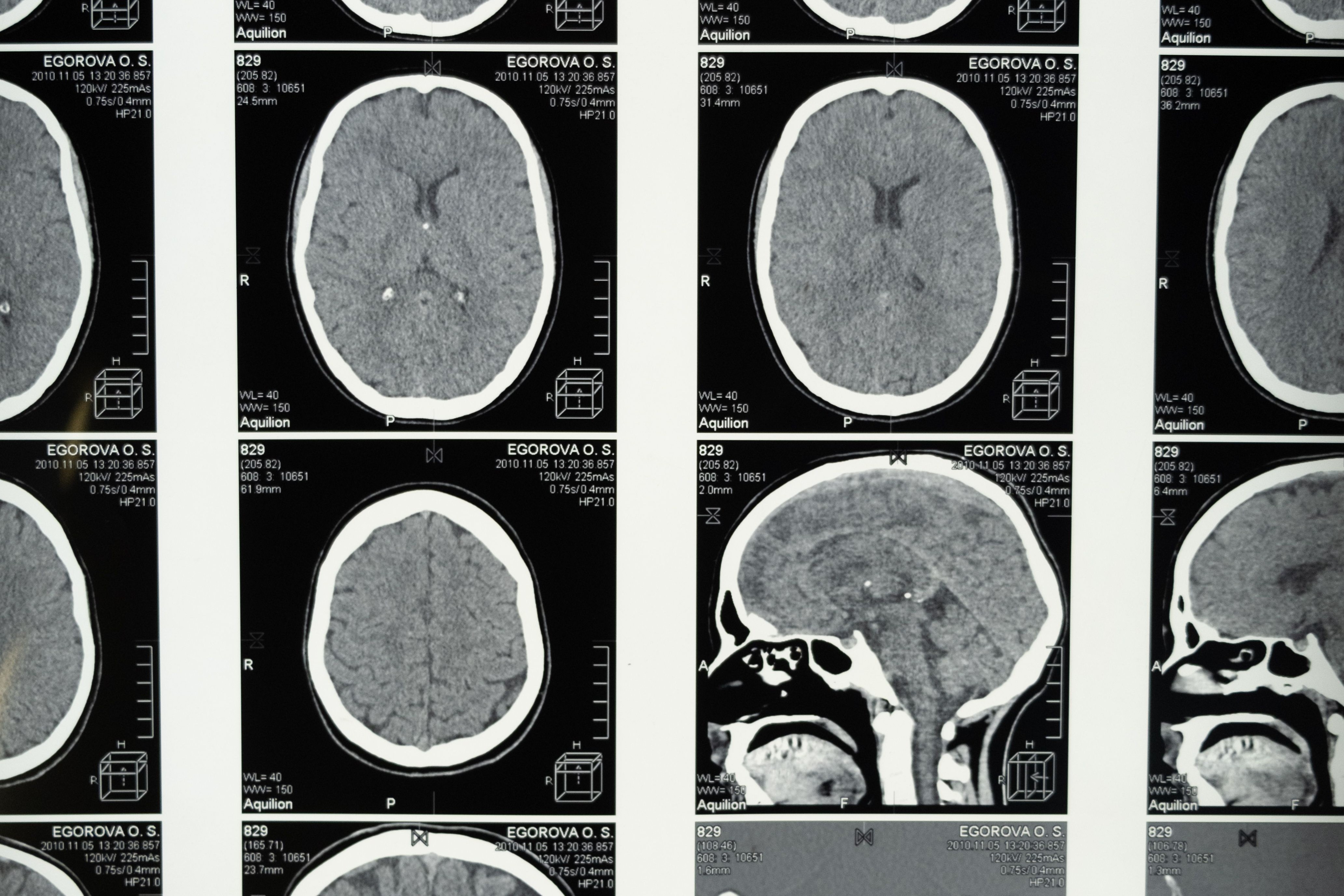 El cerebro, un último territorio por proteger
